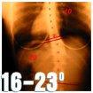Degrees of Curvature Scoliosis is a lateral deviation