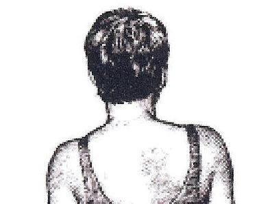 Uneven shoulder blades (scapulae) unequal distance between the arms and body.