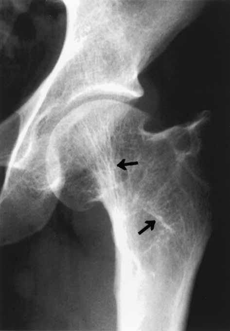 Trabeculae cross graft Grade IV Almost complete fibula 5 cases visible on radiographs ; Trabeculae cross graft Fig. 1b.