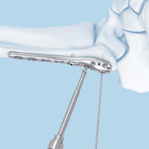 Note: To secure the plate to the fibula before locking screw insertion, it is recommended to pull the plate to the bone using a cortex screw. Nonlocking screw insertion fixation with 2.
