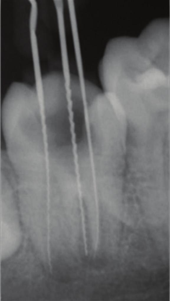 Hence, very small increments were used to enhance precise placement over the apical portion.