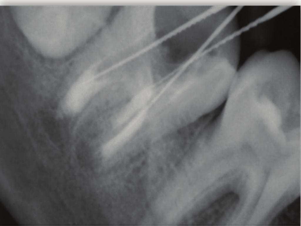 Repeated radiographs were obtained to checkadequacyofmta(figure 1(d)). The blunt end of a large paper point was moistened with water and left in the canal to promote setting for 4 6 hours.
