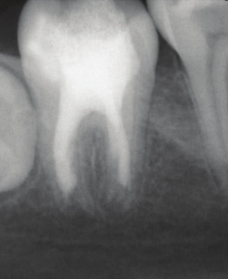 After 8-month follow-up, a periapical radiograph was exposed and it revealed that continuity in lamina dura and consistent width of periodontal ligament space suggest healing of the periapical lesion