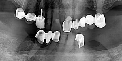 Treatment plan 1 st phase Extraction of #43 Placing implants on #34, 35 Repair of RPD to be used as a temporary denture Finishing the
