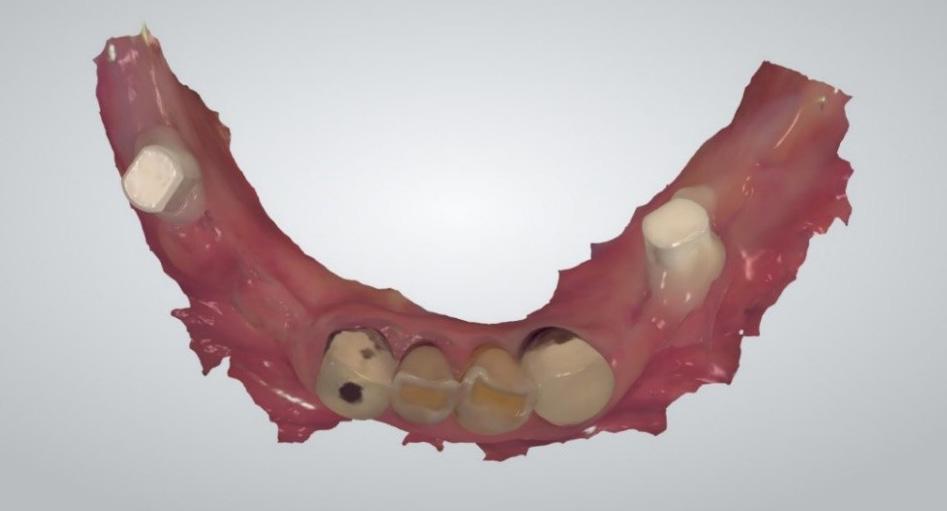 Fig. 3. TRIOS Intraoral Scan Image with Markers on Gingiva Alteration of the plan after 5 weeks from the first treatment After 5 weeks, the patient s RPD broke and was non repairable.