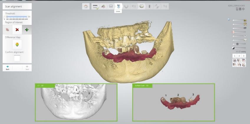 As the patient did not want to be edentulous during treatment, I suggested two ways for making a temporary prosthesis.
