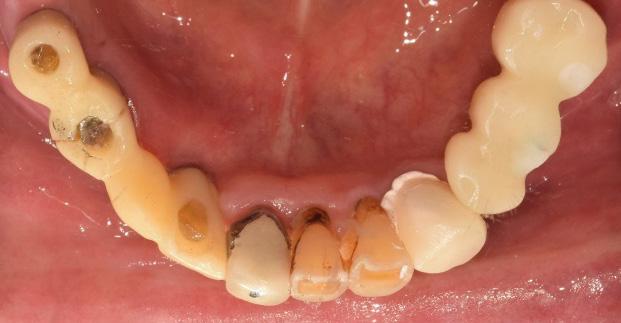 New PMMA crowns were seated on the left side.