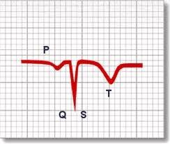 Picture 5: description of different types of curve Picture 6 Record of ECG curve by modern 12 lead device Conductive system of the heart : the speed and regularity of the heart activity is governed