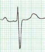 In first-degree atrioventricular block the cardiac rhythm originates in the sinus node and the atrioventricular node conducts each electrical impulse to the ventricles, but slower than normal.