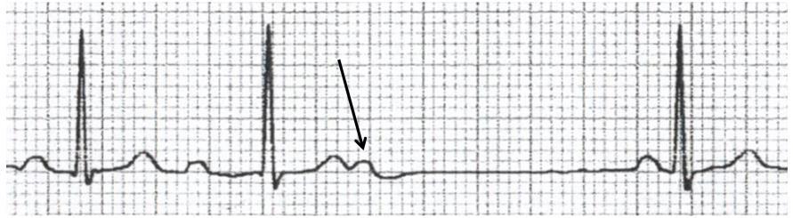 depolarization of the ventricles is abnormally delayed the PQ (PR) interval is longer than normal (above its upper limit of 210 msec). Figure 12. First-degree atrioventricular block.