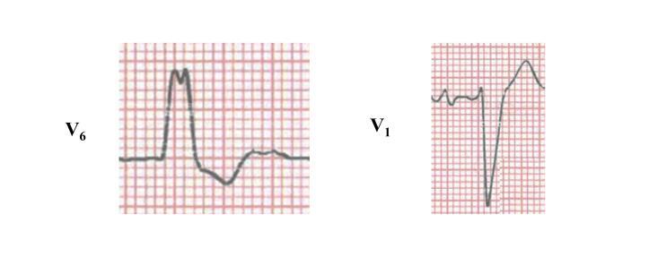 or rsr -shaped QRS complexes in the right precordial leads (V 1 and V 2 ) - deep and broad S waves in the lateral leads (I, avl, V 5, V 6 ) - right axis deviation due to the abnormal terminal QRS