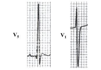 6.2. Ventricular hypertrophy Ventricular hypertrophy is characterized by unusually tall R waves and unusually deep S waves in the left or right precordial leads, depending on the affected ventricle