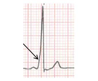 8. Other electrocardiographic abnormalities 8.1.