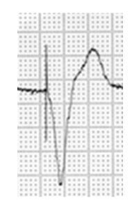 Figure 23. Ventricular stimulation by an artificial pacemaker. Note the stimulation spike preceding the broad, deformed QRS complex. 8.3. Electrolyte disorders In case of hyperkalemia, narrow and tall T waves appear on the ECG trace (Figure 24).