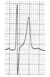 As serum potassium concentration continues to rise, PQ intervals become longer, P waves loose amplitude and may disappear, and QRS complexes widen.