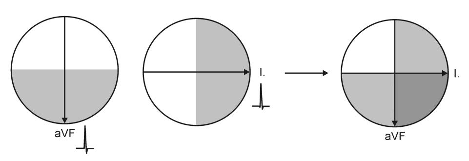 Figure 5. Quick determination of the mean QRS axis using the quadrant method (example).