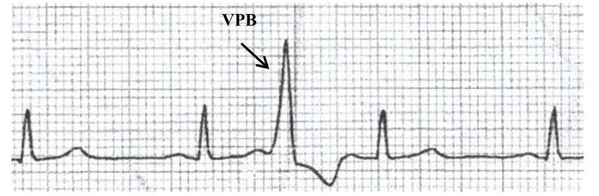 along the His bundle and bundle branches, but directly through the ventricular myocardium, on a cell-to-cell basis (See lecture notes).
