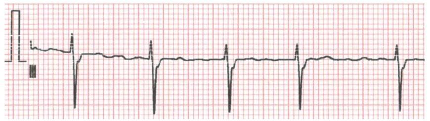 Atrial fibrillation is the most common cardiac arrhythmia found in clinical practice.