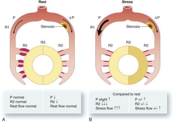 Effect of Coronary Stenosis