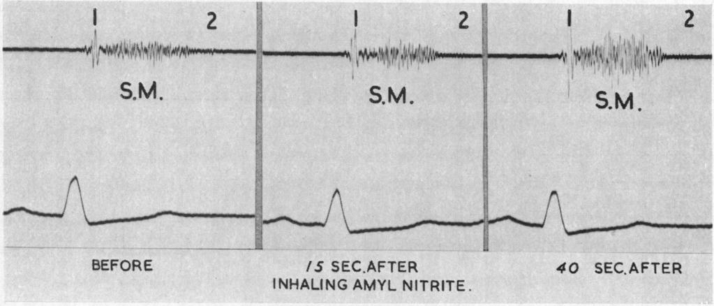 FIG. AMYL NITRITE IN DIFFERENTIATION OF SYSTOLIC MURMURS BEFORE 15 SEC.AFTER 40 SEC.AFTER INHALING AMYL NITRITE. 3.