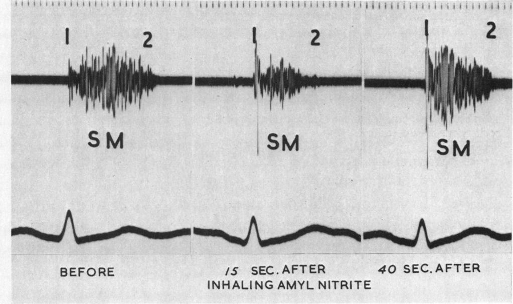 murmur up to 40 seconds. 1 2 2~~~~~~~~~ 1 2 1 SM ism ism BEFORE /5 SEC. AFTER 40 SEC.AFTER INHALING AMYL NITRITE FiG. 4.-The effect of inhaling amyl nitrite on the combined murmurs of aortic stenosis and mitral regurgitation.