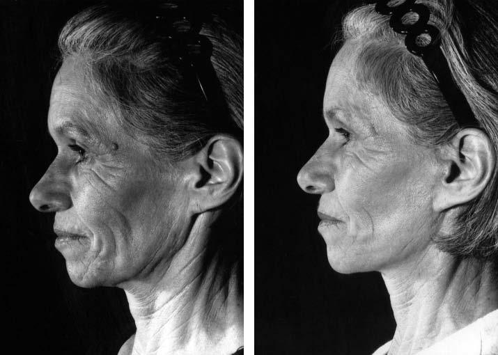 Volume 120, Number 6 Comparison of Face Lift Techniques Fig. 1. Patient 5a (left) preoperatively and (right) 22