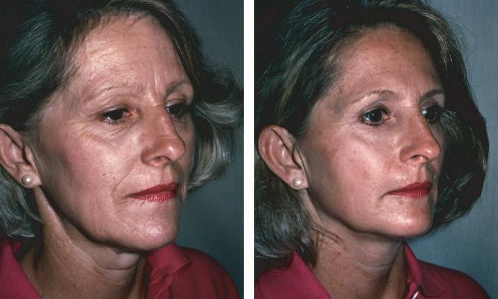 Plastic and Reconstructive Surgery November 2007 Fig. 7. (Left) Twin with a 30-pack-year history of cigarette smoking. Note the advanced signs of aging as compared with her nonsmoking twin (right).