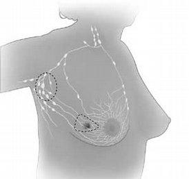 Breast-conserving surgery. Dotted lines show area containing the tumor that is removed and some of the lymph nodes that may be removed.