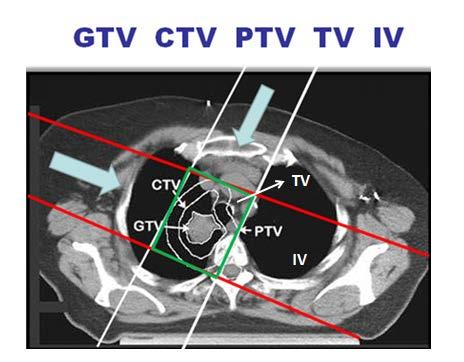 Session 9a - From GTV to PTV / 479 Revisiting ICRU volume definitions Author(s): ROSENBLATT, Eduardo 1 Introduction The Applied Radiation Biology and Radiotherapy (ARBR) Section of the IAEA considers