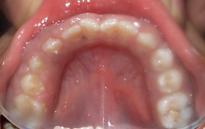 On the basis of history and clinical presentation, a provisional diagnosis of hereditary gingival overgrowth was made