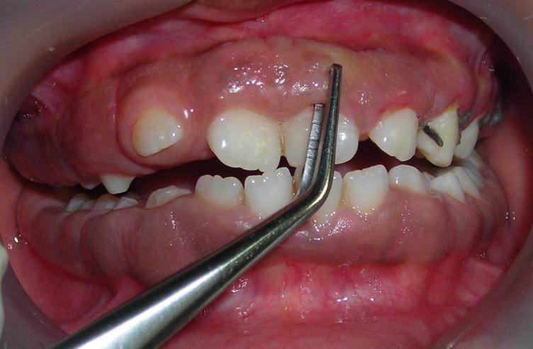 In this case, treatment was carried quadrant-by-quadrant gingivectomy.