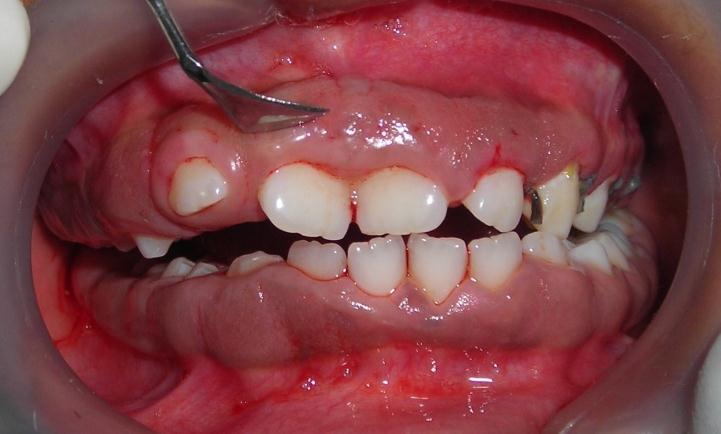 7), then excessive gingival tissue was removed by using gingivectomy knives(kirkland knife, Orbans interdental knife) (Figure 8, Figure 9), the area was thoroughly irrigated with normal saline and