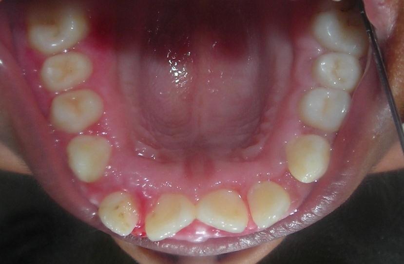 Gingival fibromatosis may exist as an isolated finding or as part of a more general syndrome.