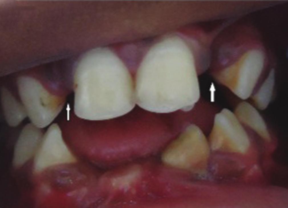 with short roots irt 32; impacted tooth with conical crowns and short root irt 42; radiolucency involving enamel dentin and pulp irt 36 with horizontal and vertical bone loss was seen [Figure 7].
