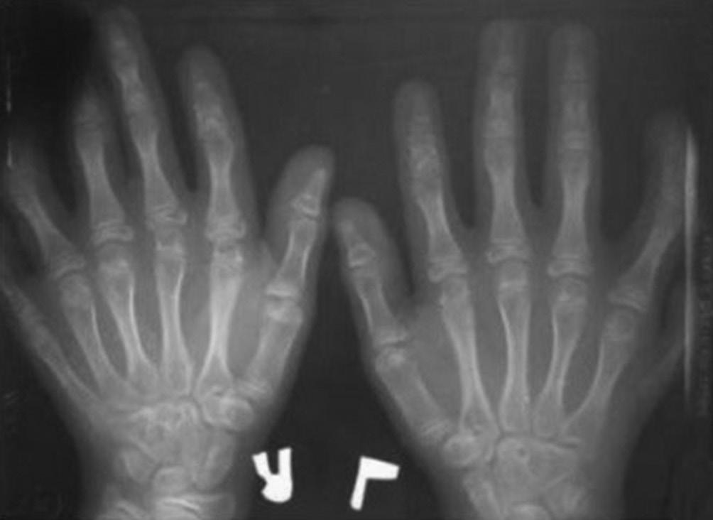 Figure 9: Radiograph of hands and wrist showed polydactyly. Figure 10: Echocardiogram revealing no abnormality. bone development in the alveolar ridge, as is known to occur with other bones.