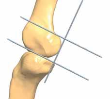 joint and parallel to the tibial plateau.