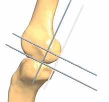 femoral  ❸ Move the proximal parallel wire (II) down to the centre of the  Measure the