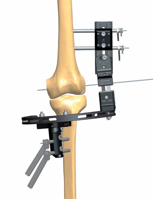 18 OPERTIVE TECHNIQUE 10 Insert the rail with a straight clamp on the hinge. Position the straight clamp 15-20 mm from the hinge. Ensure that the rail is in line with the anatomical axis of the femur.