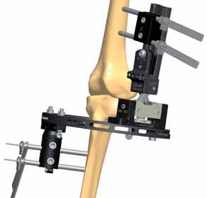 Insert the wires. ttach a Sheffield Clamp to the ring on the medial aspect of the tibia. Insert 2 wire guides into the screw guides positioned in the screw seats 2 and 5 of the Sheffield Clamp (fig.