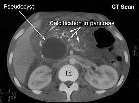 There is significant overlap in the causes of acute and chronic pancreatitis.