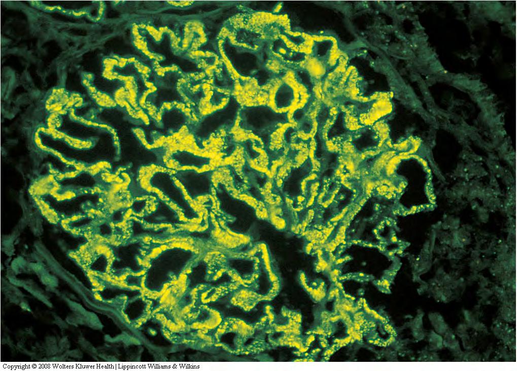 A B Immunofluorescence: A: Granular deposits of IgG