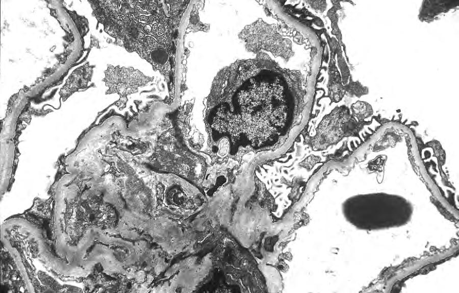 A B EM: The glomerular capillary