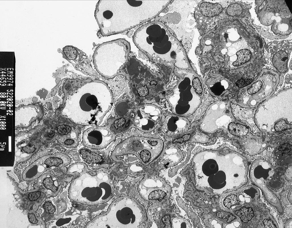 EM: Different glomerulonephritic diseases show immune deposits seen as electron dense areas in