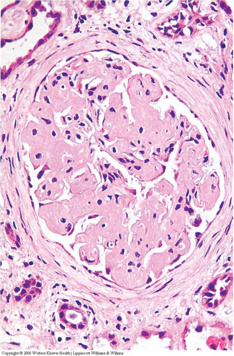 Renal amyloidosis is a cause of nephrotic syndrome and chronic renal failure. Amyloid is a pathologic extracellular protein that can develop in a variety of diseases.