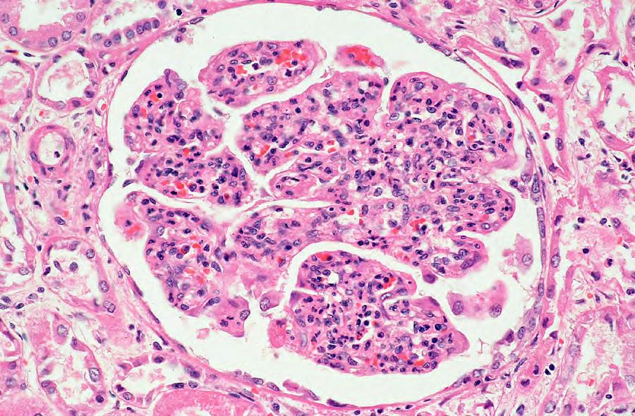 Normal glomerulus Hypercellular glomerulus with infiltrate of neutrophils