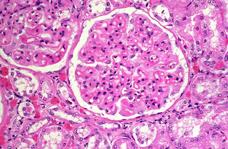 Thickened glomerular capillary walls (yellow arrows) in