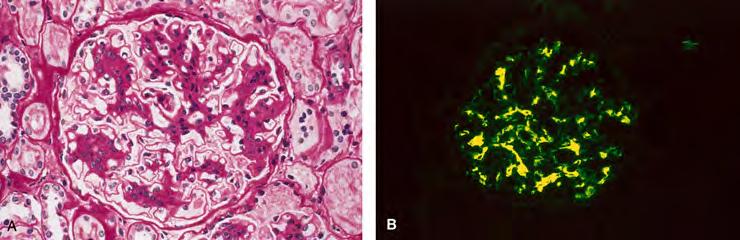 A: Mesangial hypercellularity and increased mesangial matrix in IgA nephropathy B: Immunfluorescence microscopy