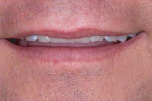 11 BEFORE AFTER teeth. Traditional veneers are extremely effective smile since each tooth visible when you smile can be treated.