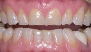 12 BEFORE AFTER treatments do not alter your natural teeth and