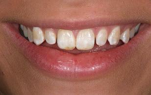 13 for these types of veneers though. The best results are for people who have small, short or spaced out teeth.